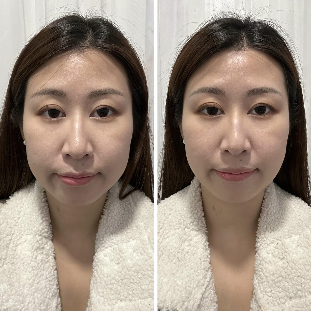 《 台北醫美分享 》台北東妍診所|IG 電波+第三代海芙音波 《 台北醫美分享 》台北東妍診所|IG 電波+第三代海芙音波
