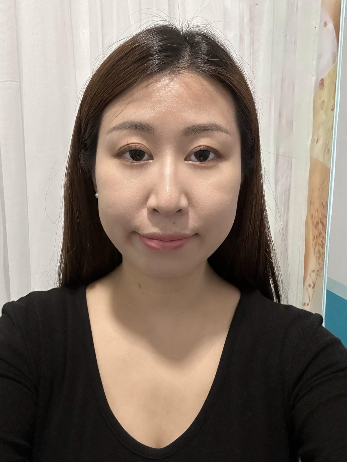 《 台北醫美分享 》台北東妍診所|IG 電波+第三代海芙音波 《 台北醫美分享 》台北東妍診所|IG 電波+第三代海芙音波
