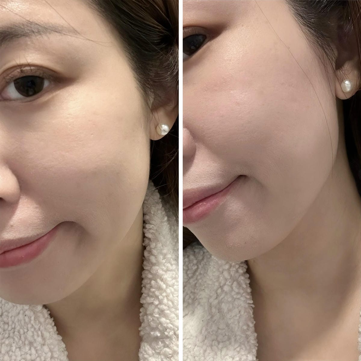《 台北醫美分享 》台北東妍診所|IG 電波+第三代海芙音波 《 台北醫美分享 》台北東妍診所|IG 電波+第三代海芙音波